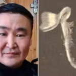a-42-year-old-russian-man-suffers-months-of-agonising-headaches-after-a-seed-sprouts-inside-his-eye.avif